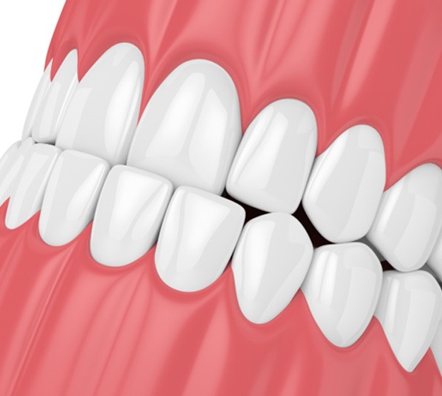 Illustration of a mouth with a slight underbite