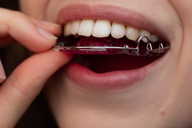Close-up of woman putting on a Hawley retainer