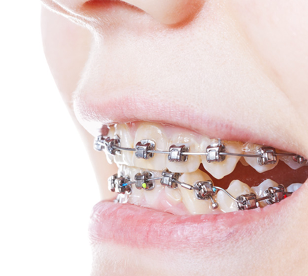 Close-up of person’s smile with braces