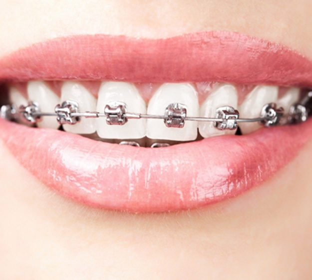 Close-up of woman’s smile with metal braces