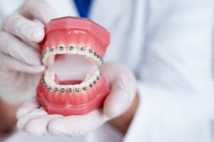Mouth model with braces being held by dentist.