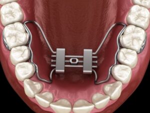 Illustration of palatal expander attached to teeth 