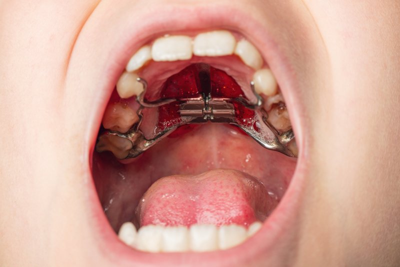 up-close view of child’s palatal expander